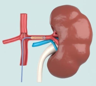 catheter in renal artery